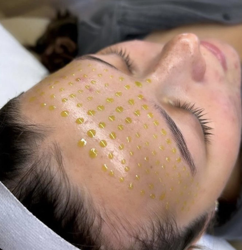 Microneedling serum dots on forehead